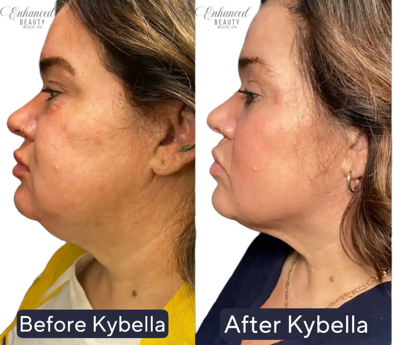 Enhanced Beauty Medical Spa kybellas BA_in Wheelersburg, OH