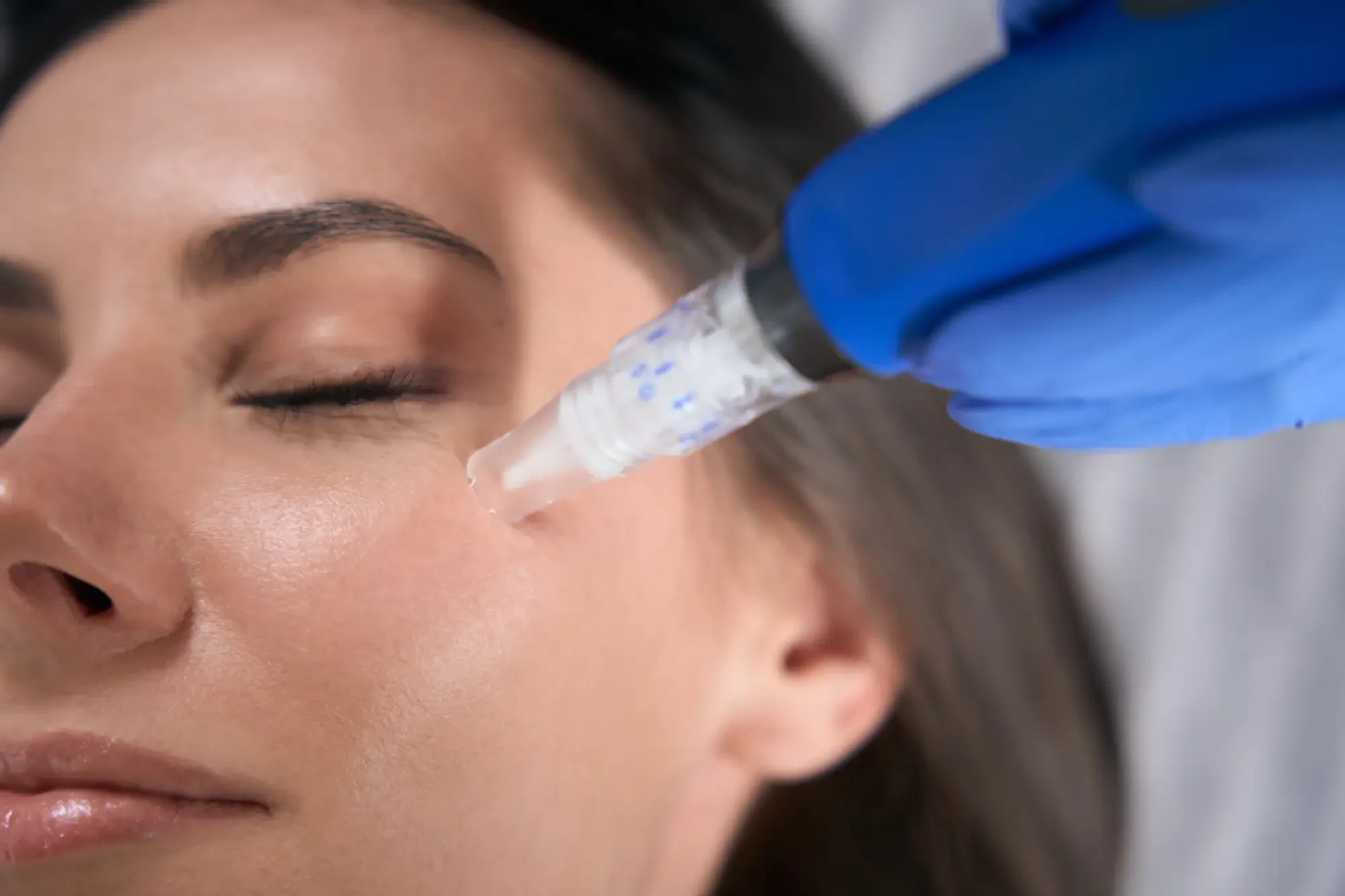 Enhanced Beauty Medical Spa microneedling a_in Wheelersburg, OH