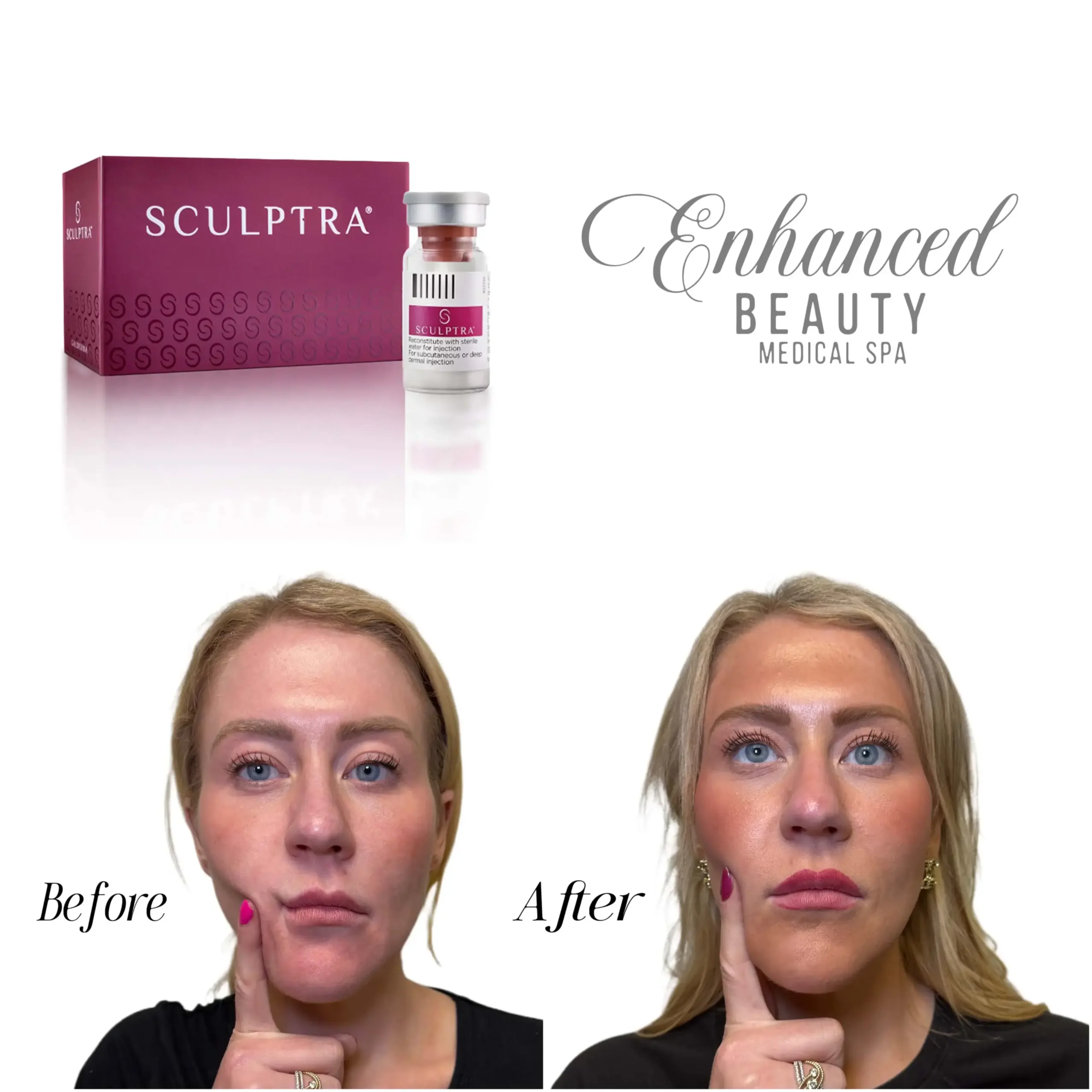 Sculptra B&A 3