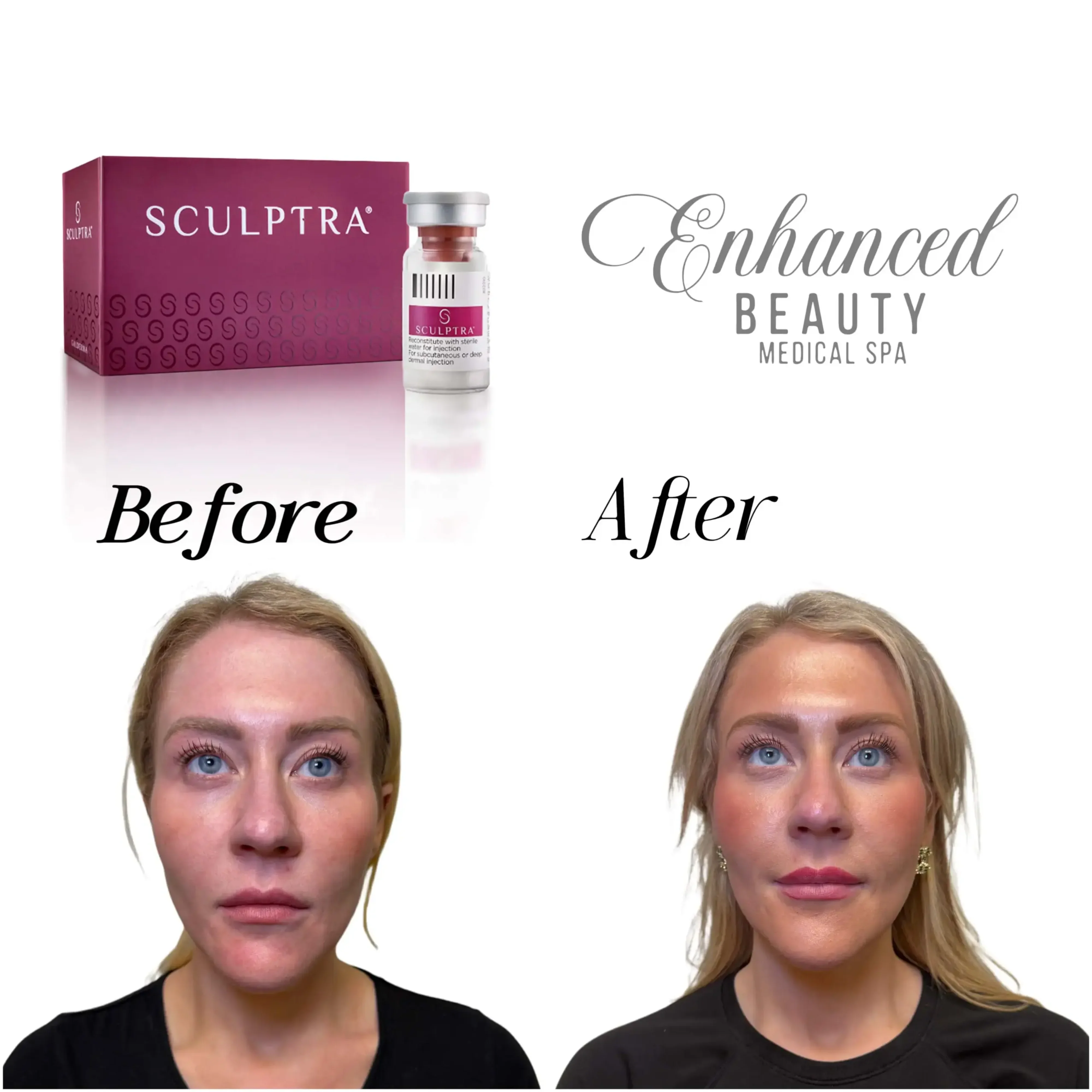 Sculptra B&A2