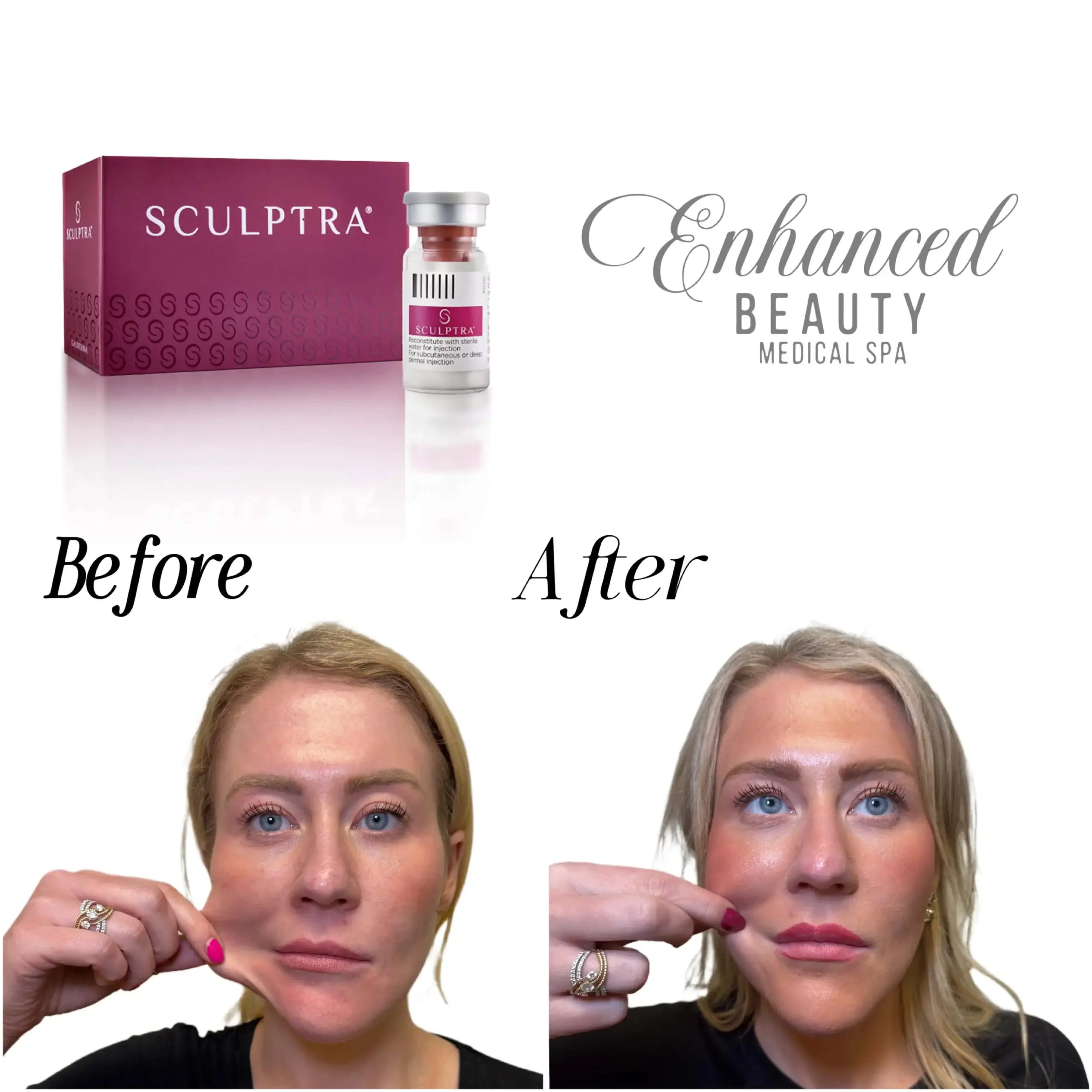 SculptraB&A